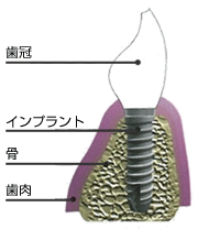 歯科用インプラントの構造について